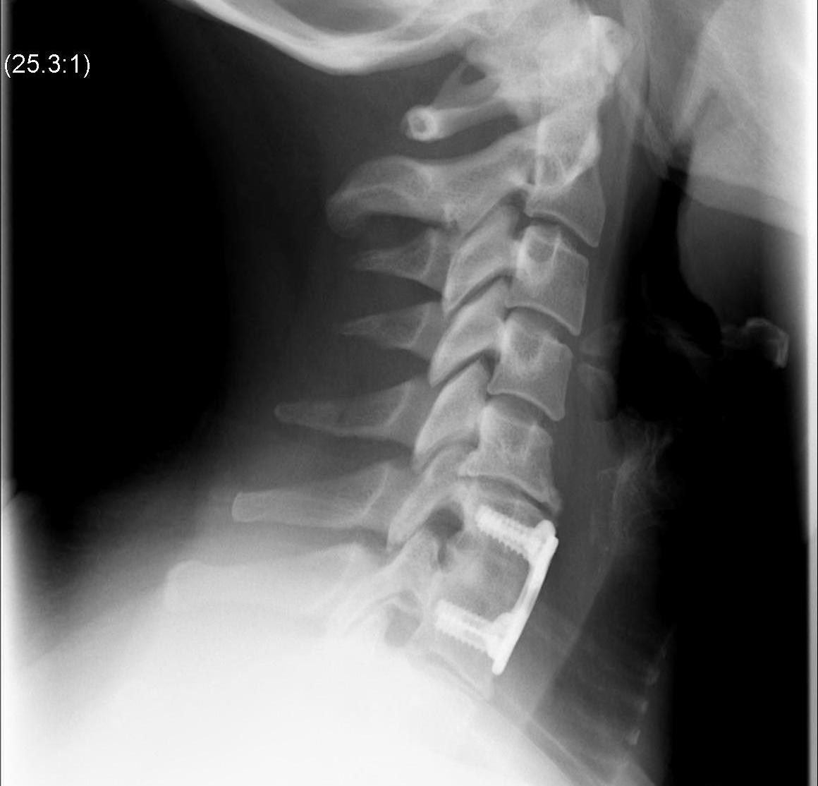 Cervical Disc Degeneration Above Fusion